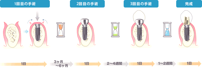 インプラント治療の手順