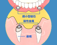 マグフィット（磁石式入れ歯）